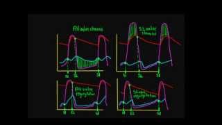 Schneid Guide to Effects of Heart Valve Lesions on the Wiggers Diagram [upl. by Jaehne]