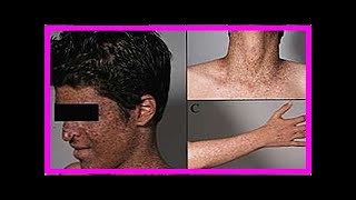 Xeroderma pigmentosum was es ist Symptome und wie die Behandlung ist [upl. by Enitnemelc81]