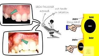 Adenomatoid odontogenic tumor [upl. by Sirrot209]