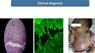 Epidermolysis Bullosa  Spot Diagnosis  9  Pediatrics [upl. by Feliks]