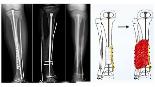 Congenital Pseudarthrosis of Tibia [upl. by Levinson691]