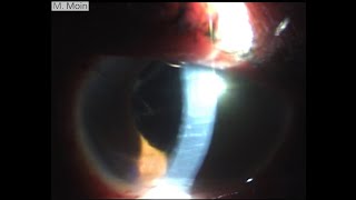 Aphakia Post Endopth IOL removal PPV [upl. by Leventis]