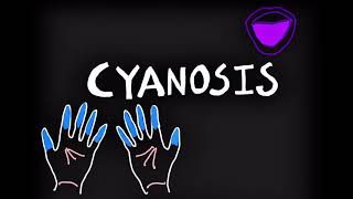 Cyanosis CauseTypesClinical features [upl. by Imrots994]