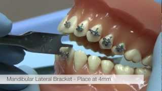 American Orthodontics Alexander LTS Brackets  Bracket Placement Video [upl. by Fassold712]