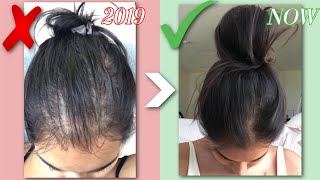 HOW I GREW MY HAIR BACK NATURALLY  QampA BEFORE amp AFTERS HAIR LOSS STORY  RESULTS IN JUST 1 MONTH [upl. by Blankenship]