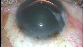 Intravitreal injection of Bevacizumab or Ranibizumab  Pradip Mohanta [upl. by Anayit]