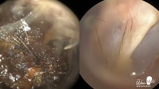 157  Severe Ear Wax Extraction From Difficult Twisty Ear using the WAXscope®️ [upl. by Boarer]