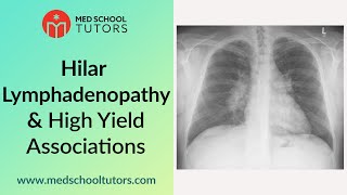 CXRs Hilar Lymphadenopathy and High Yield Associations for the USMLE [upl. by Halden]