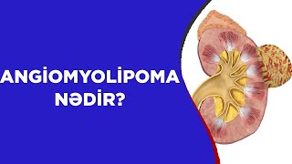 ANGİOMYOLİPOMA NƏDİR❓ [upl. by Akeret]