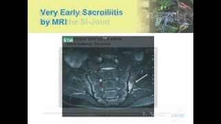 Spondyloarthritis Current Classification and the Implications for Clinical Practice [upl. by Eizzik]