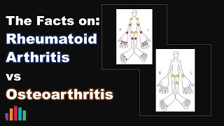 Rheumatoid Arthritis versus Osteoarthritis [upl. by Primaveria518]