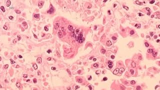 Measles could be easier to get than COVID19 UCSF doctor says Heres his warning as cases rise [upl. by Uase]