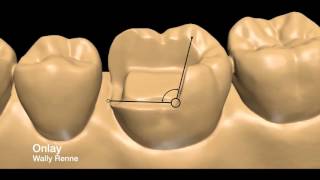 Posterior tooth preparations inlay onlay crownlay and crown [upl. by Agler335]