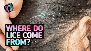 Your Body On Lice Warning Distressing Footage [upl. by Meli]