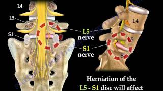 Low Back Pain  Disc Herniation Sciatica  Everything You Need To Know  Dr Nabil Ebraheim [upl. by Airdni]