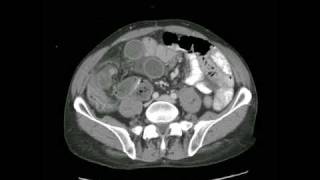 Radiology Rounds  radRoundscom Closed Loop Small Bowel Obstruction [upl. by Airitak]