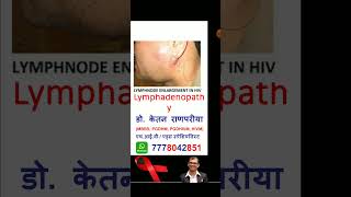 lymphadenopathy hiv hivsymptoms hivtest hivtesting [upl. by Aseel]