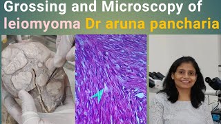 Leiomyoma fibroid grossmicroscopypathology histopathology mbbs uterusproblemeducational [upl. by Veron]