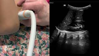 Pediatric RenalBladder Scan Demo R kidney long axis [upl. by Aerdnat625]