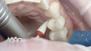 SpeedCEM Plus  Assemblage due couronne en zircone sur pilier implantaire [upl. by Enom]