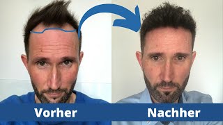 Haartransplantation Geheimratsecken Vorher Nachher im Schnelldurchlauf  Elithair [upl. by Zachery896]