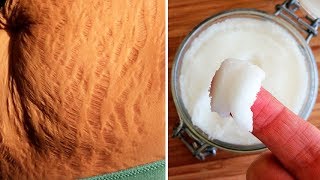 How to Get Rid of Stretch Marks Naturally [upl. by Imeon292]