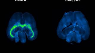 Blocking p120catenin thwarts brain tumors [upl. by Eanyl414]