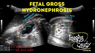 Fetal Unilateral Hydronephrosis  Ultrasound  Anomaly  Case 44 [upl. by Roana3]