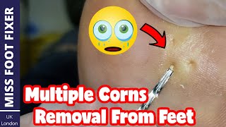 Satisfying Corn Removal  Multiple Corns On Foot Removal Full Treatment By Miss Foot Fixer [upl. by Burnsed]