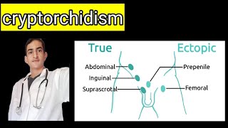 cryptorchidîsm [upl. by Isaac]