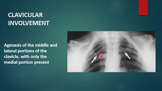 CLEIDOCRANIAL DYSPLASIA  Xray  Radiology [upl. by Ylagam]