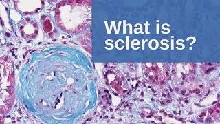 What is Sclerosis  Pathology mini tutorial [upl. by Nivag677]