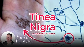 12 Tinea nigra Palmaris amp Piedra [upl. by Cindelyn]