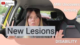 Multiple Sclerosis MRI  New and old active lesions [upl. by Nolrah422]