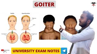 Goitre  Hypothyroidism amp Hyperthyroidism  Endocrine Physiology [upl. by Cherri533]