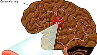 Intracerebral HemorrhageICHEtiology PathophysiologyClinical Features Diagnostic Treatment [upl. by Saibot444]