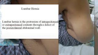 Lumbar Hernia Case amp Description [upl. by Eseekram]