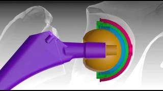 Hip Implant Failure Cause amp Process [upl. by Eeram921]