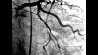 Coronary angiography indications [upl. by Kelila805]