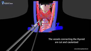 Endoscopic Thyroidectomy [upl. by Aicena411]