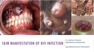 HIV associated skin manifestations HIV dermatology funny skincareeducation funny [upl. by Eiroj]