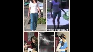 علاج حالات اعوجاج العمود الفقريالظهر بدون جراحه ج ١ Scoliosis Cshape conservative treatment [upl. by Leerzej]