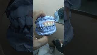 Valplast 4 gigi dentist doktergigi gigitiruan vidioshorts [upl. by Toombs]