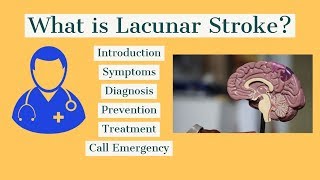 How to treat lacunar Stroke [upl. by Nawoj]