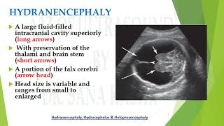 Hydranencephaly fluid filled fetal brain differentials  A2Z of Ultrasound [upl. by Ilyk]