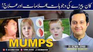 MUMPS SYMPTOMS amp HOME TREATMENT Mumps treatment [upl. by Dania]