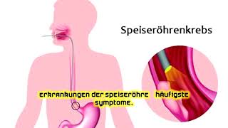 Erkrankungen der Speiseröhre – häufigste Symptome [upl. by Lemieux461]