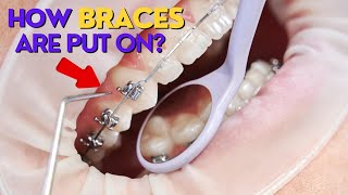 How Braces are Put On  A Step By Step Process [upl. by Zosema]