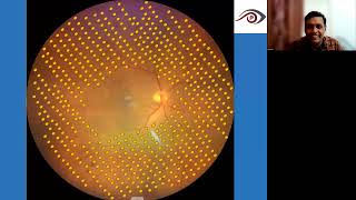 Lecture The Role of Lasers in Diabetic Retinopathy [upl. by Lehcear]