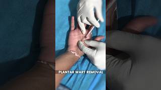 Plantar Warts Removal Treatment at Skinaa Clinic viral shorts [upl. by Mcdade]